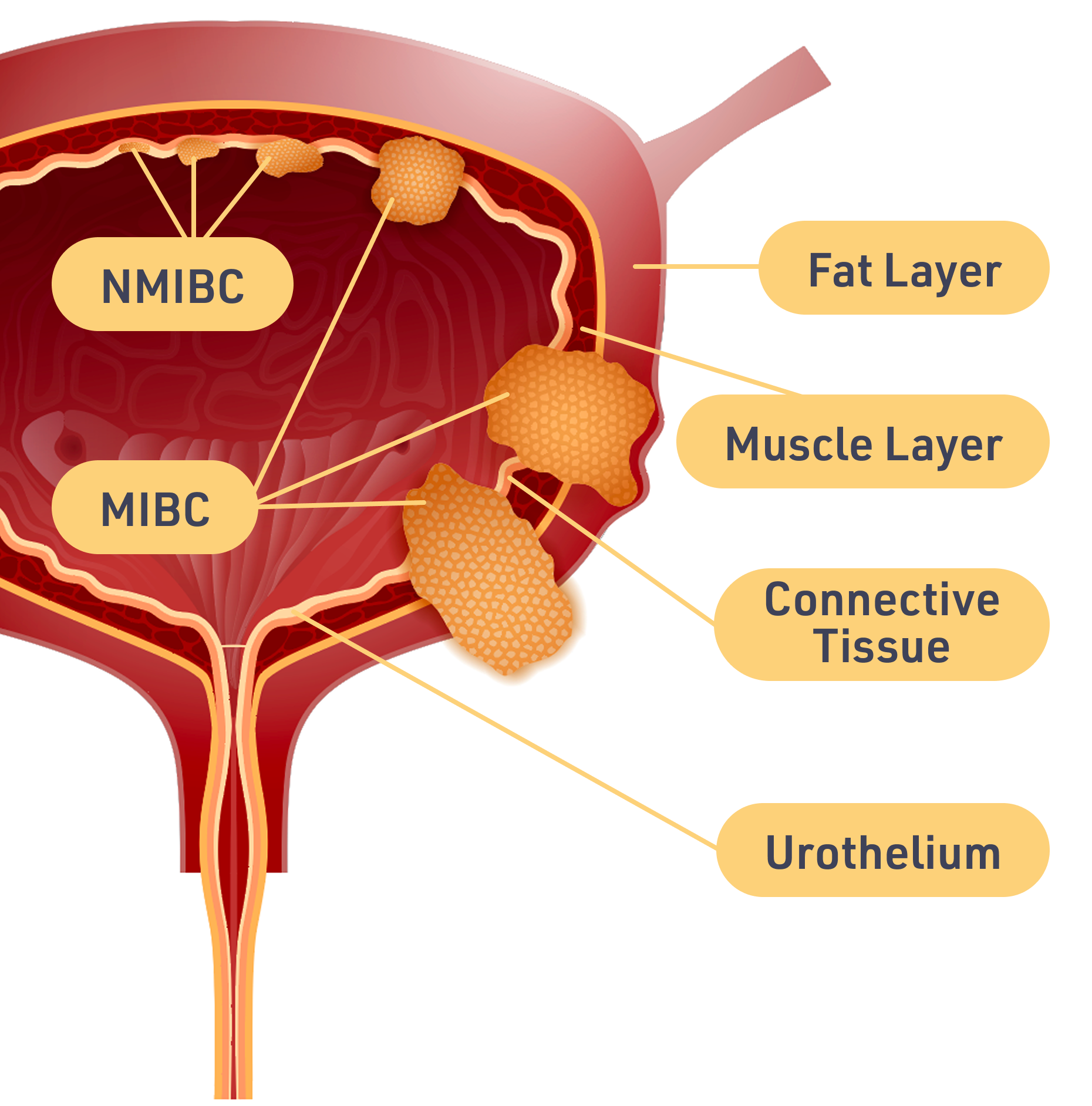 Bladder Cancer Illustration