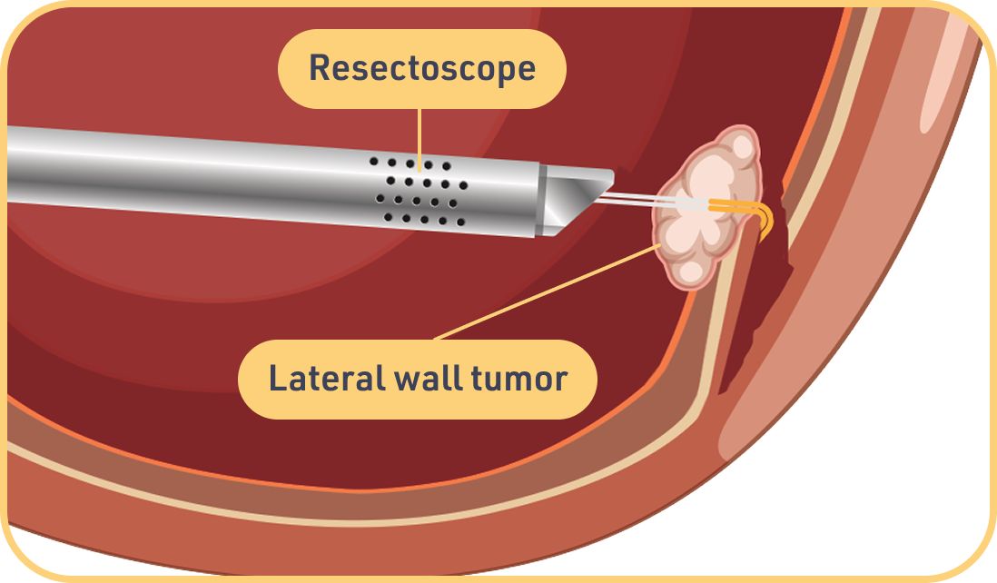 TURBT Procedure with Resectoscope Illustration