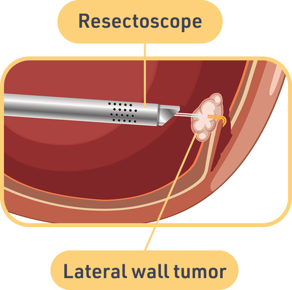TURBT Procedure with Resectoscope Illustration