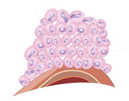 Low-Grade Cancer Cells