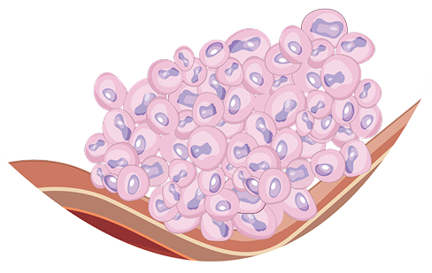High-Grade Cancer Cells